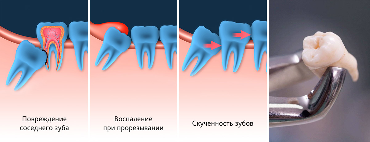 Основная причина удаления зубов мудрости